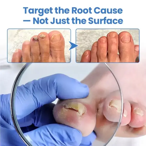 MycoErase Nail Revive Pen