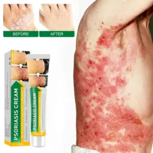 Psoriasis Cure Cream