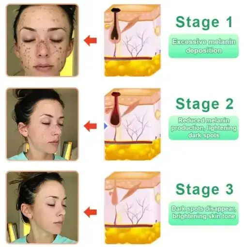 Purifying Exfoliating Gel for Acanthosis Nigricans