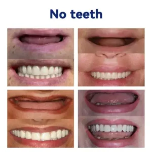 Silicone Denture Ruler Set