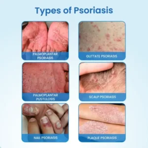 Timilk® MagnesiumHerb Psoriasis Relief Cream
