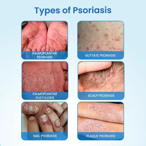 Timilk® MagnesiumHerb Psoriasis Relief Cream