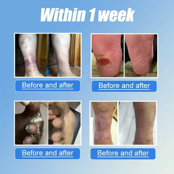 VitaGluco Diabetes Treatment Cream