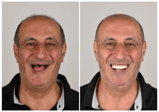 3D Dentures