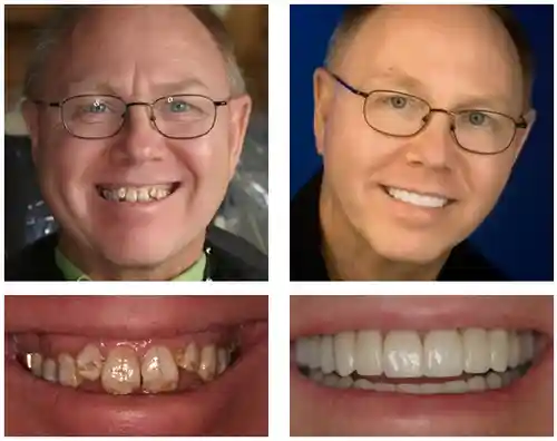 3D Dentures