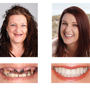3D Dentures