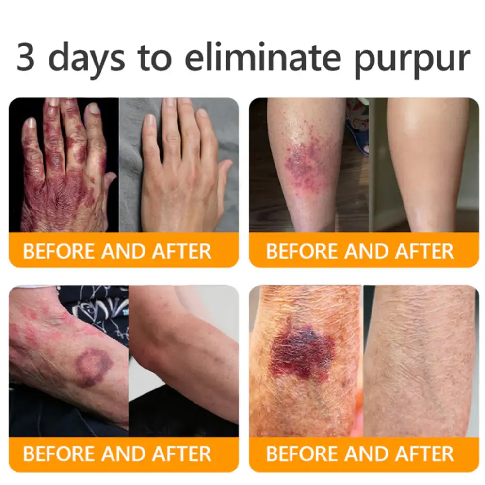 𝐓𝐚𝐥𝐥𝐨𝐰 𝐁𝐞𝐞 𝐕𝐞𝐧𝐨𝐦 𝐒𝐤𝐢𝐧 𝐑𝐞𝐬𝐭𝐨𝐫𝐚𝐭𝐢𝐨𝐧 𝐂𝐫𝐞𝐚𝐦 - Image 2