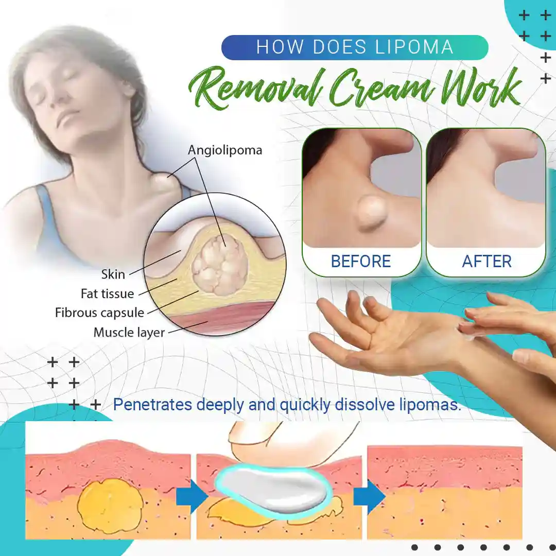 Cvreoz Lipoma Removal Cream - Image 4