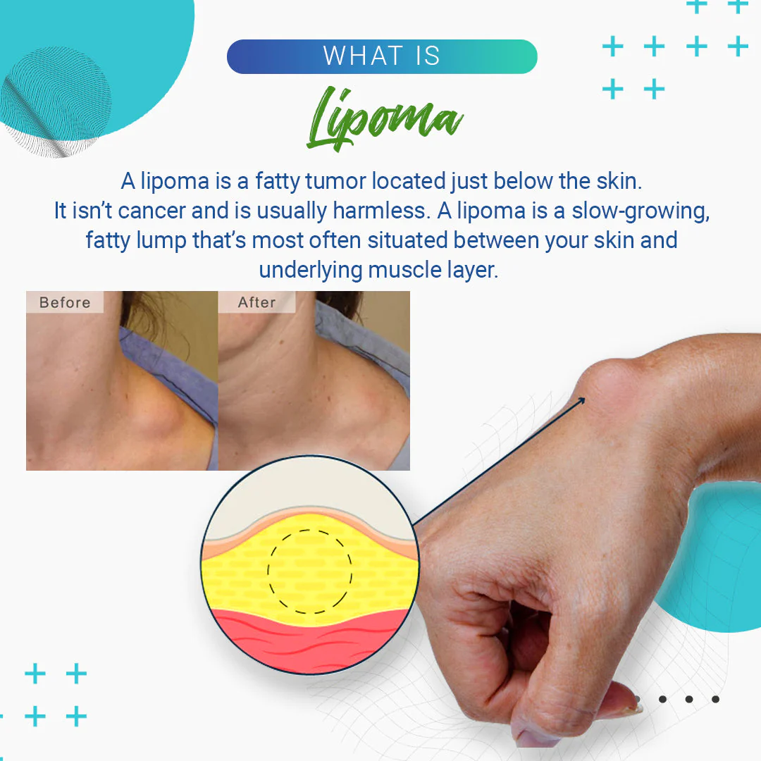 Cvreoz Lipoma Removal Cream - Image 6