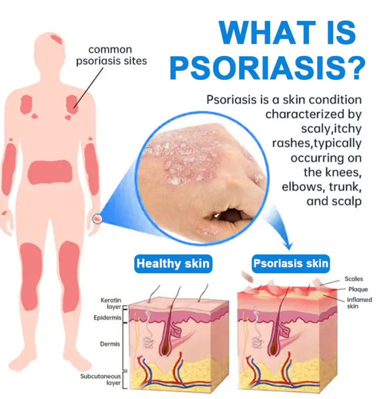 Magnesium Herbal Psoriasis Spray - Image 7