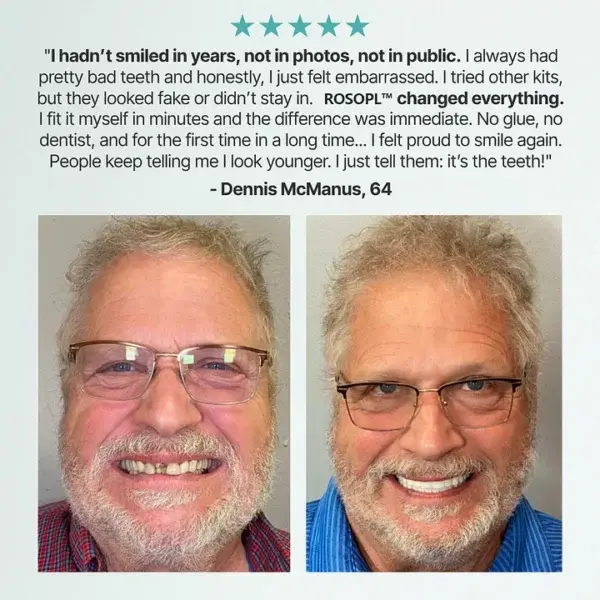 Custom Dentures for a Perfect Confident Smile! - Image 5