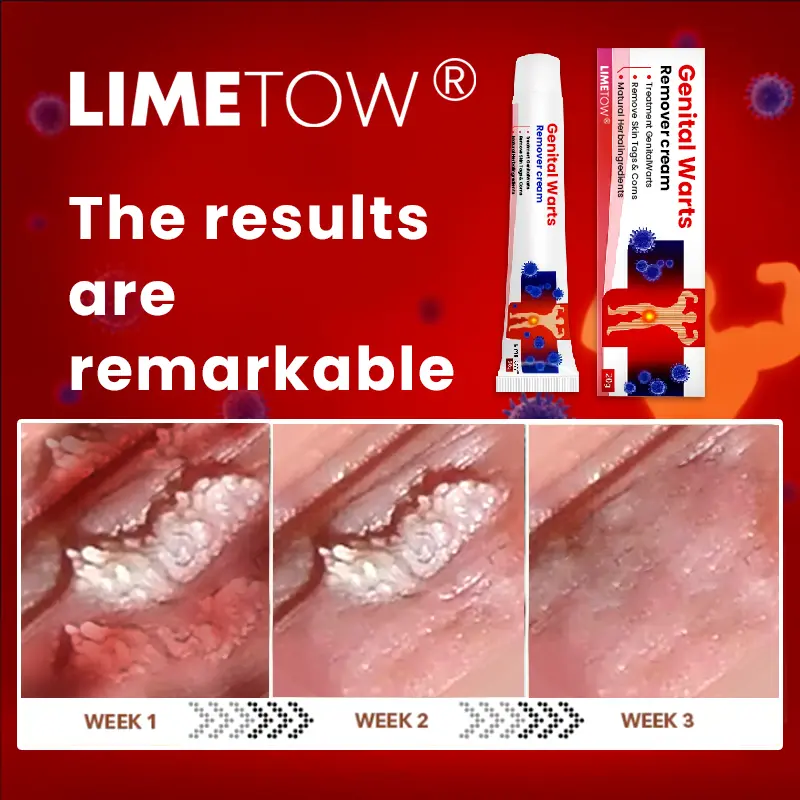Genital Warts Remover Cream - Image 10