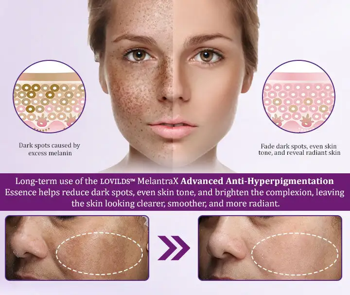MelantraX Advanced Anti-Hyperpigmentation Essence - Image 9