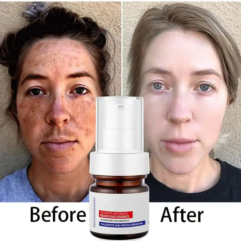 WHITENING ANDFRECKLE REMOVING ESSENCE - Image 2