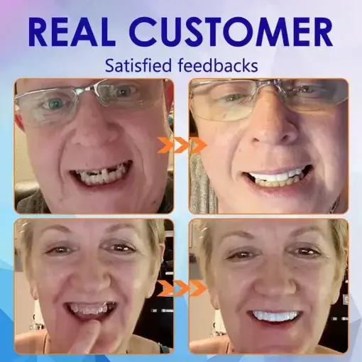 Advanced Customized Full Denture Set - Image 10