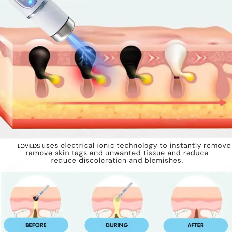 Non-Invasive Mole and Wart Removal Laser Pen - Image 9