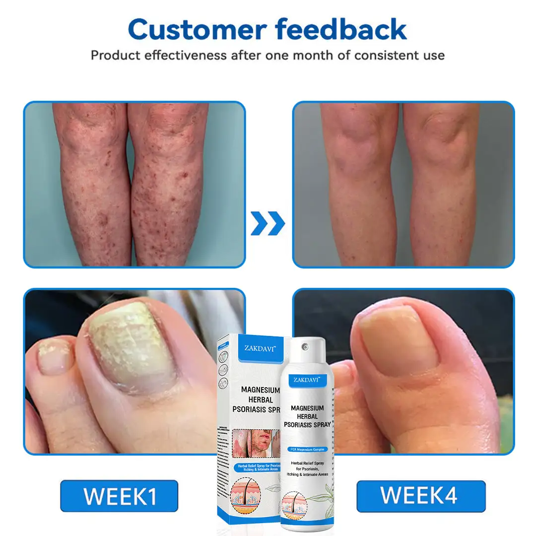 Magnesium Herbal Psoriasis Spray - Image 8