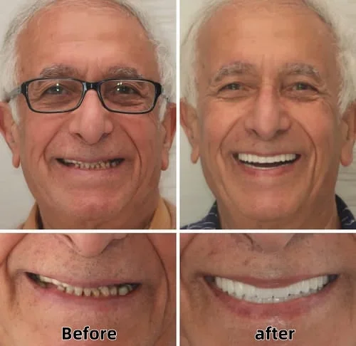 Custom Functional Denture Kits - Image 4