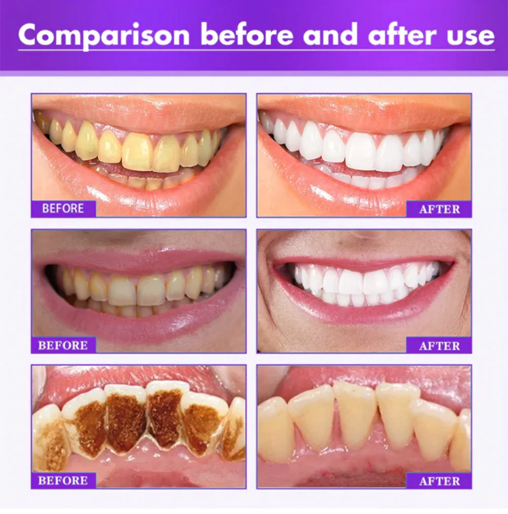 Teeth Repairing Foam - Image 3