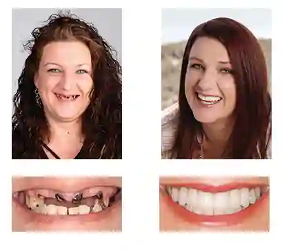 3D Dentures - Image 5