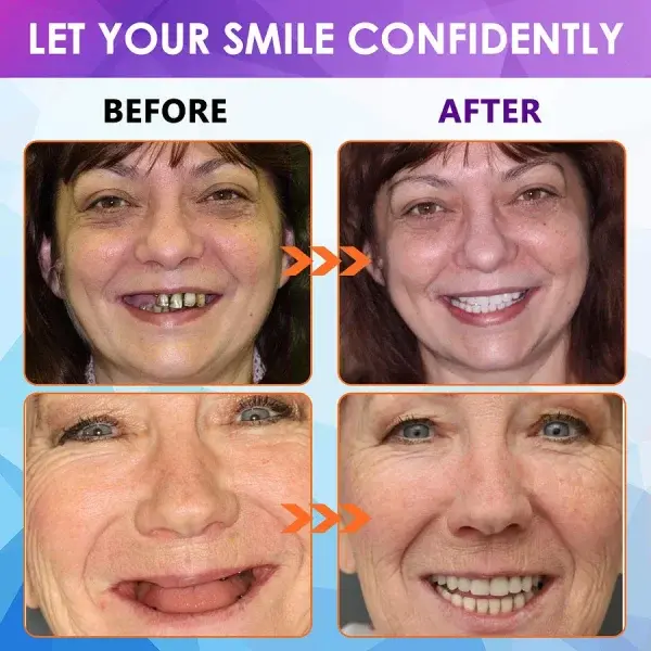 Advanced Customized Full Denture Set - Image 9