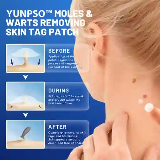 Moles & Warts Removing Skin Tag Patch - Image 3