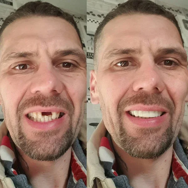 Advanced Custom-Fit Functional Dentures - Image 2