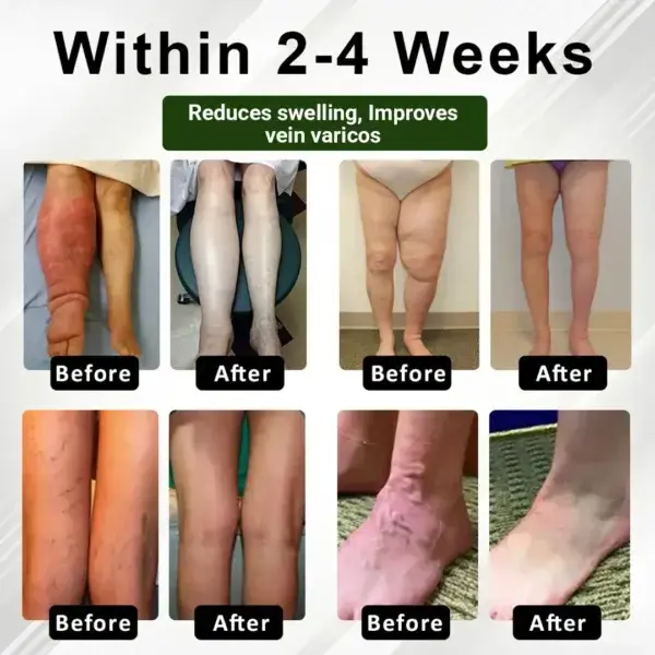 FluidEase Leg Therapy Edema Cream - Image 7