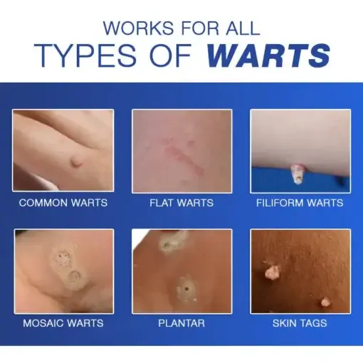 Wart Eraser Pro - Image 6