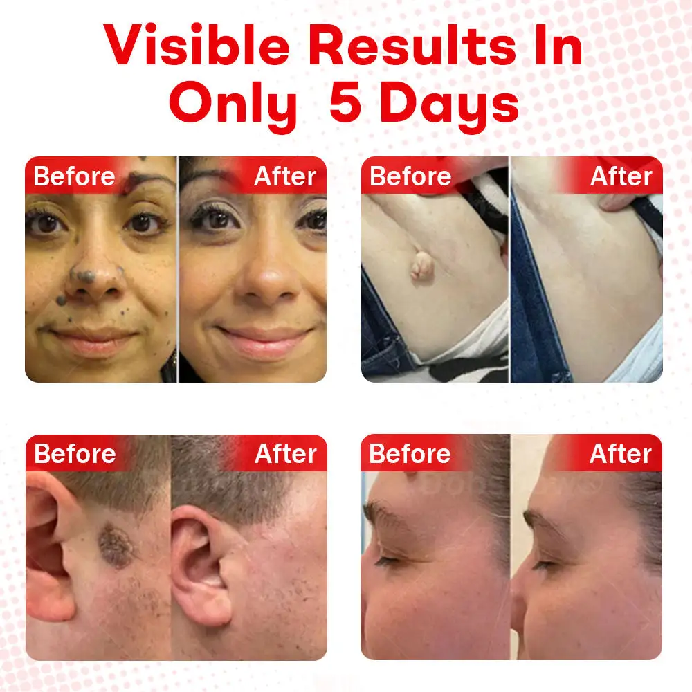 MicroNeedle BotanicSkin Tag Removal Patch - Image 4