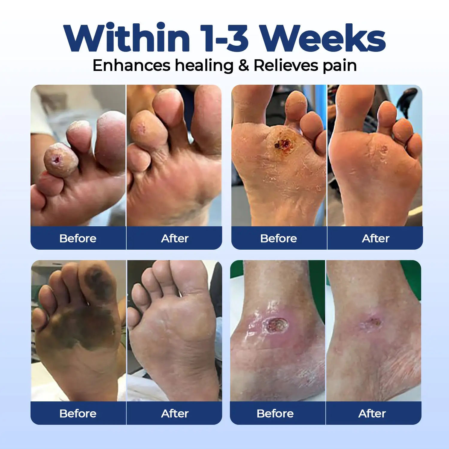 Diabetic Foot Ulcer Healing Cream - Image 4