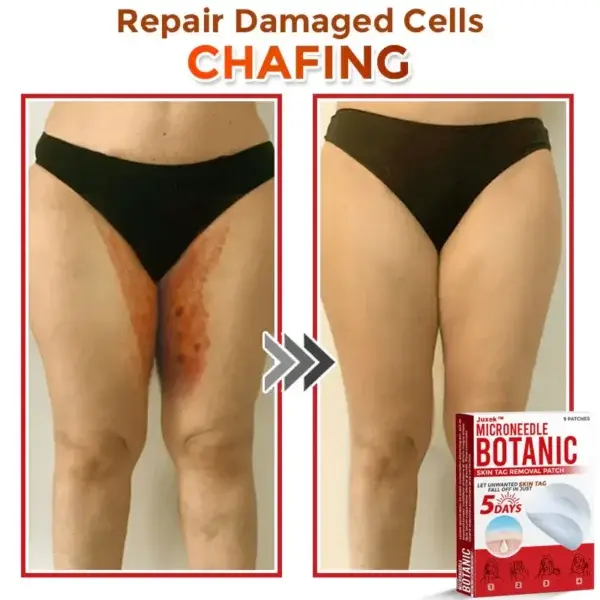 Removal Patch: Gentle Microneedle Patches for Skin Tag & Mole Removal - Image 7