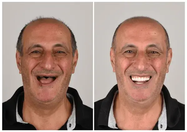 Custom-Fit Functional Dentures Smile with Confidence - Image 7