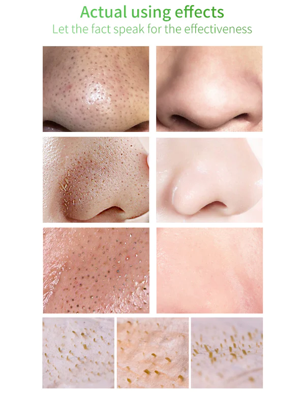 Facial Essence Blackhead Removal Kit - Image 6