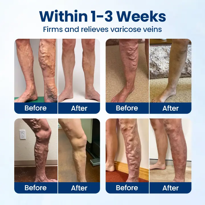 Micro-Mist Herbal Varicose Veins Spray - Image 2