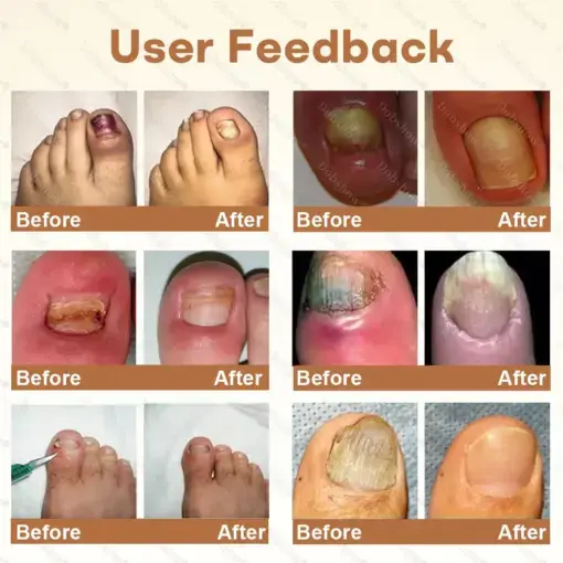 NailRescue BeeVenom Renewal Spray - Image 2