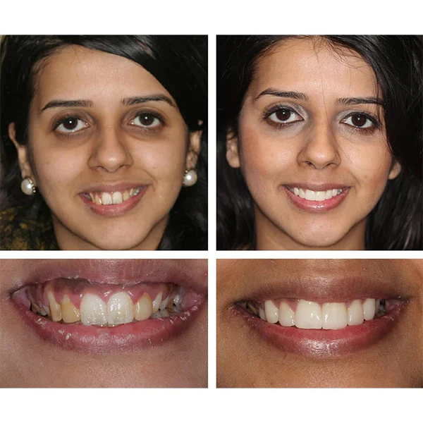 Esencia blanqueadora de dientes - Image 7
