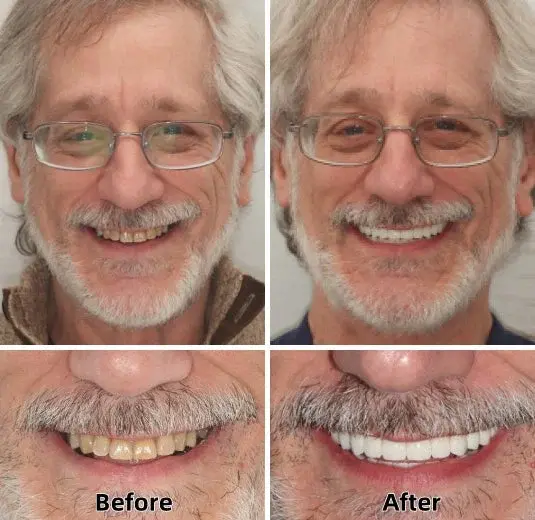 -Advanced Custom-Fit Functional Dentures - Image 4