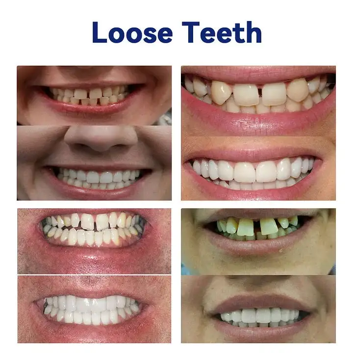 Advanced Customized Full Denture Set - Image 7