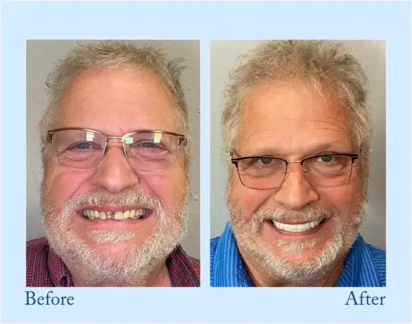 Custom-Fit Functional Dentures – Perfectly Fitted in Minutes at Home - Image 7