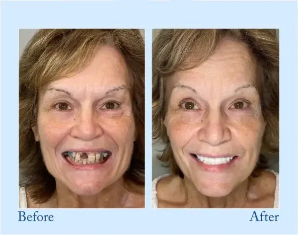 Custom-Fit Functional Dentures – Perfectly Fitted in Minutes at Home - Image 8