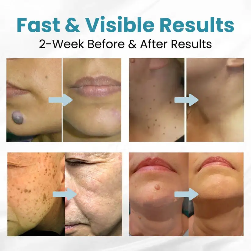 Non-Invasive Mole and Wart Removal Laser Pen - Image 6