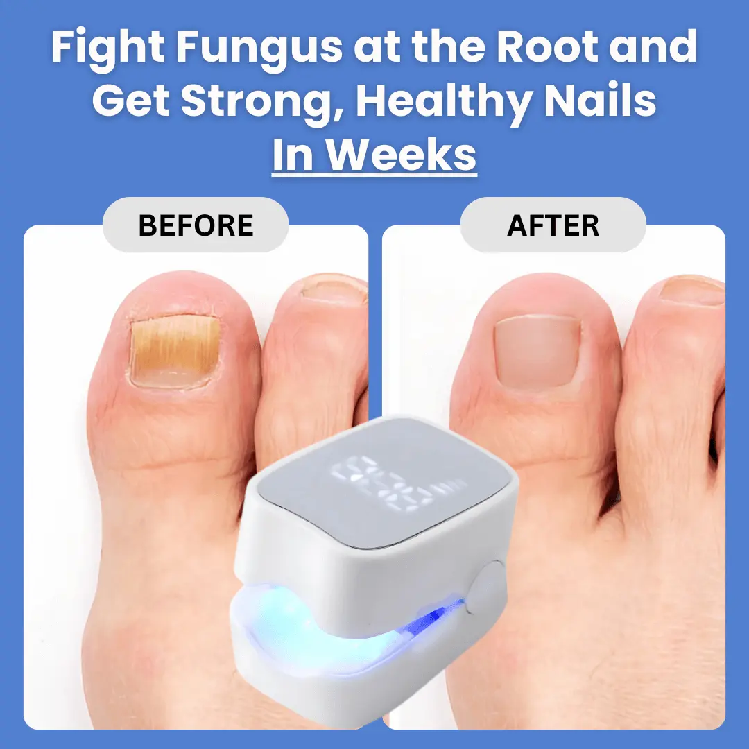- Nail Fungus Laser Device - Image 6