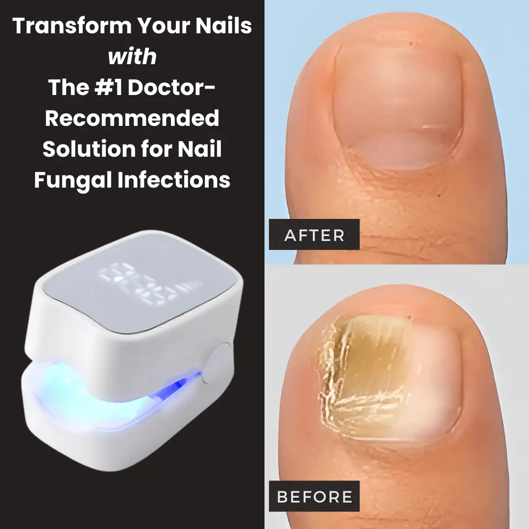 - Nail Fungus Laser Device - Image 8
