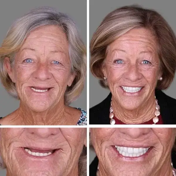 Advanced Customized Full Denture Set - Image 10