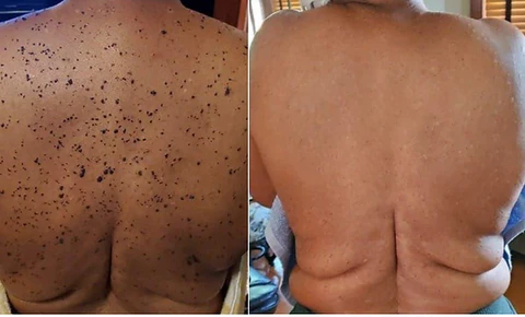 BEE VENOM Wart & Mole Removal Cream - Image 3