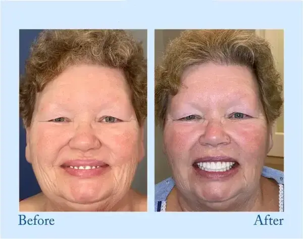Dentures - Image 11