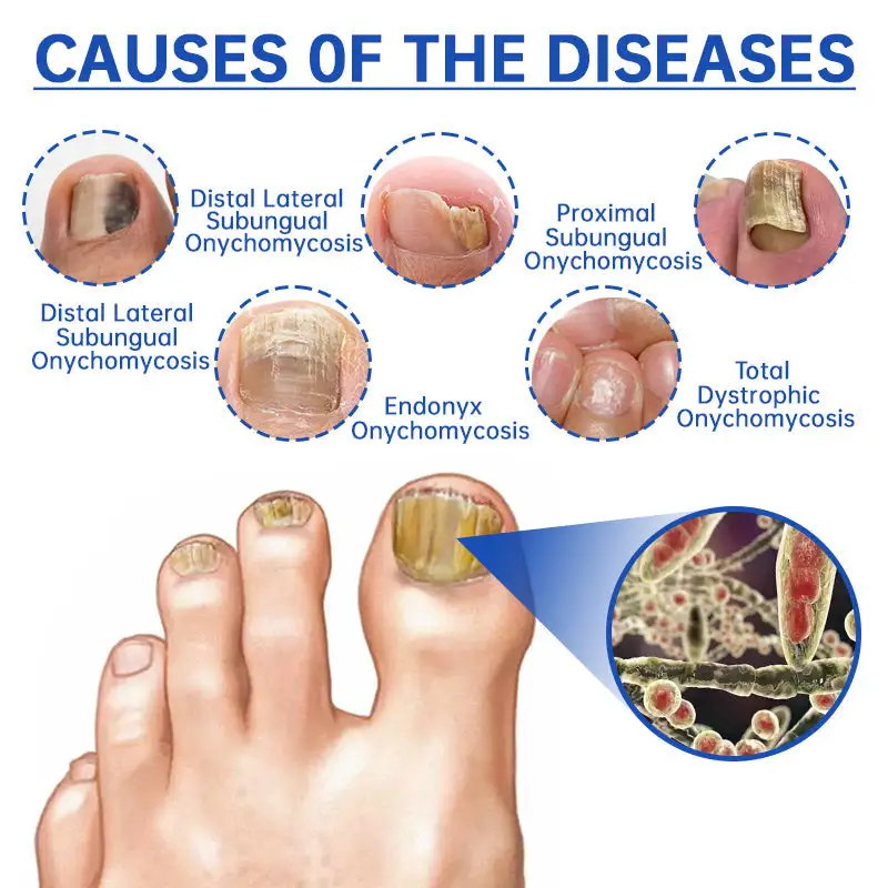PureNail Fungus Laser Device - Image 8
