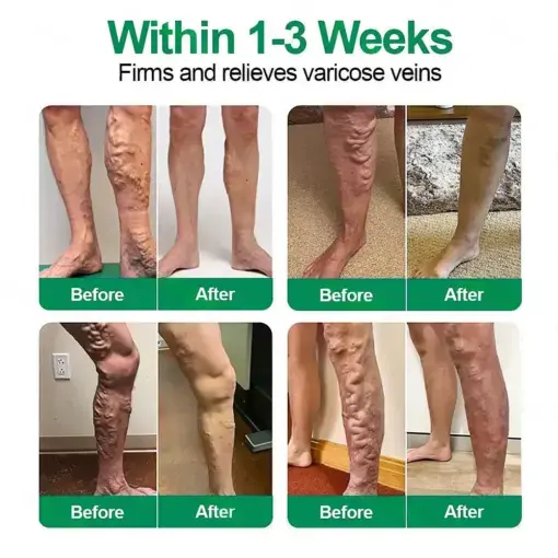 VeinTarget Microneedle Patch Once Daily, Visible Results in 7 Days - Image 2