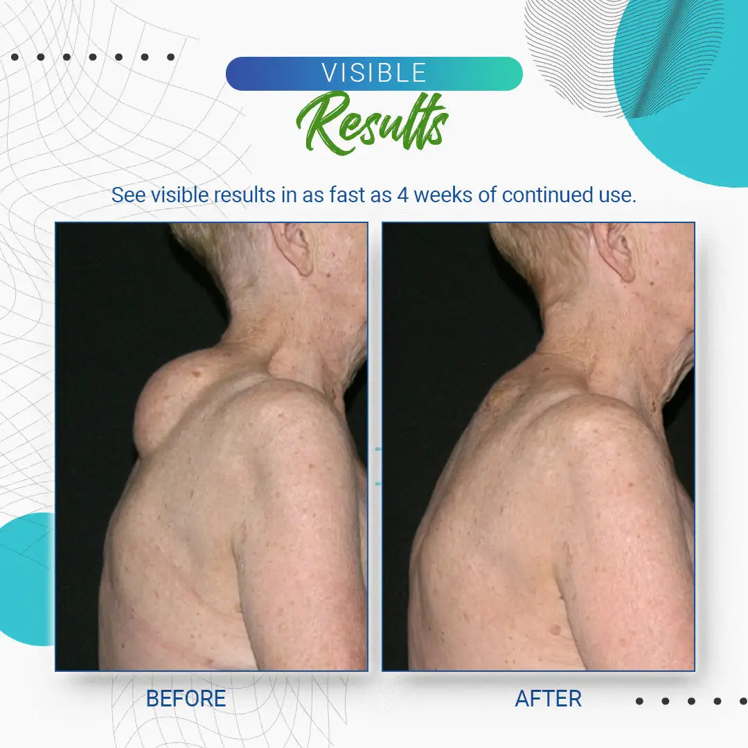 Lipoma Removal Cream - Image 9
